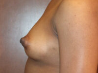 before breast augmentation left side view of female patient 2042