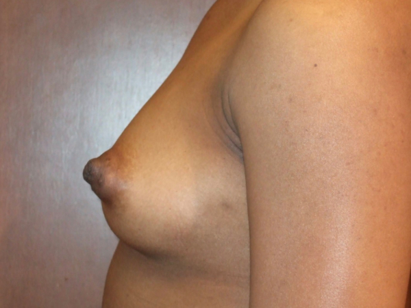 before breast augmentation left side view of female patient 2042