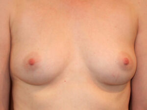 before breast augmentation front view of female patient 2054