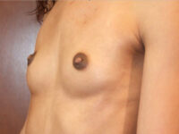 before breast augmentation left angle view of female patient 2065