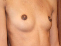 before breast augmentation right angle view of female patient 2065