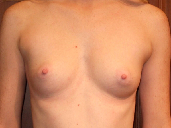 before breast augmentation front view of female patient 2087