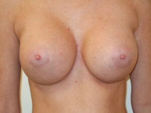after breast augmentation front view of female patient 2087