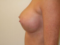 after breast augmentation left side view of female patient 2087