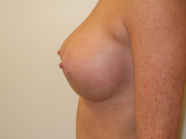 after breast augmentation left side view of female patient 2087