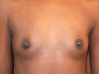before breast augmentation front view of female patient 2099