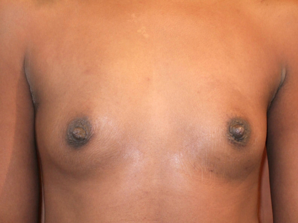 before breast augmentation front view of female patient 2099