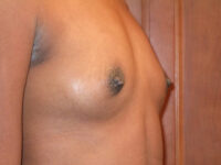 before breast augmentation right angle view of female patient 2099