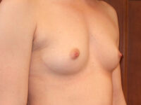 before breast augmentation right angle view of female patient 2110