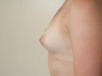 before breast augmentation left side view of female patient 2119