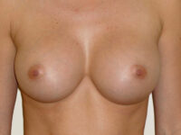 after breast augmentation front view of female patient 2134