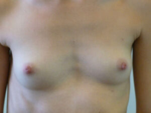 before breast augmentation front view of female patient 2147