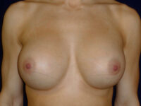 after breast augmentation front view of female patient 2147