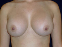 after breast augmentation front view of female patient 2166