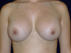 after breast augmentation front view of female patient 2166