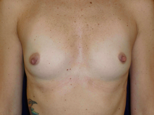 before breast augmentation front view of female patient 2177
