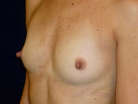 before breast augmentation left angle view of female patient 2177