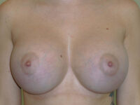 after breast augmentation front view of female patient 2190