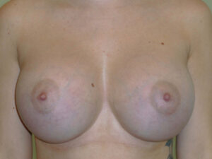 after breast augmentation front view of female patient 2190