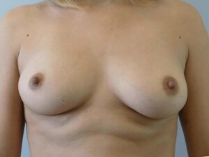before breast augmentation front view of female patient 2212