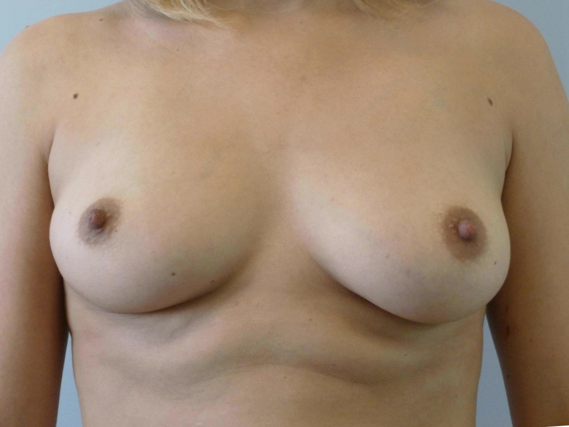 before breast augmentation front view of female patient 2212