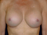 after breast augmentation front view of female patient 2235