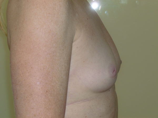 before breast augmentation right side view of female patient 2235