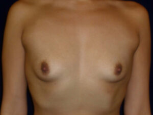 before breast augmentation front view of female patient 2246