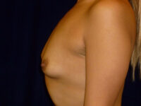 before breast augmentation left side view of female patient 2246