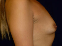 before breast augmentation right side view of female patient 2246