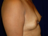 before breast augmentation right side view of female patient 2270