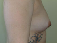 before breast augmentation right side view of female patient 2277