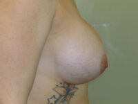 after breast augmentation right side view of female patient 2277
