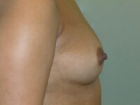before breast augmentation right side view of female patient 2288