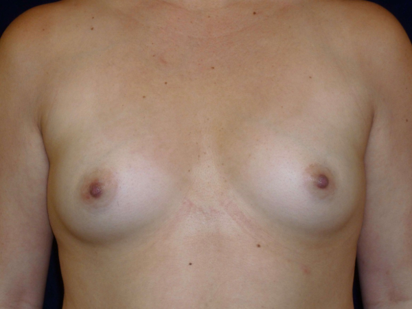 before breast augmentation front view of female patient 2301