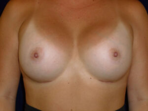 after breast augmentation front view of female patient 2301