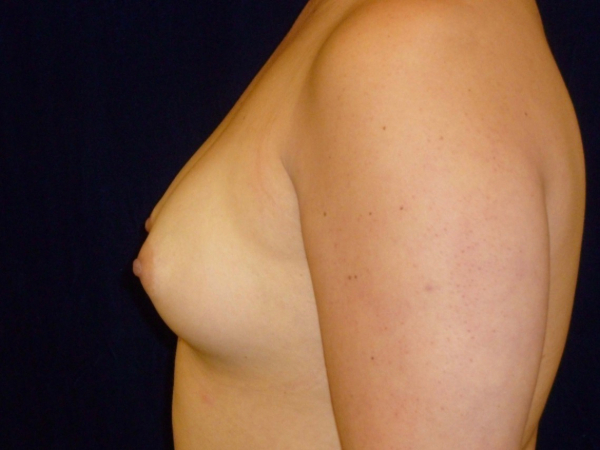 before breast augmentation left side view of female patient 2301