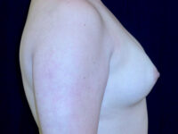 before breast augmentation right side view of female patient 2301