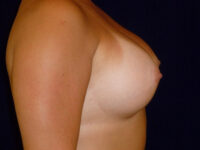 after breast augmentation right side view of female patient 2301