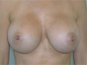 after breast augmentation front view of female patient 2312