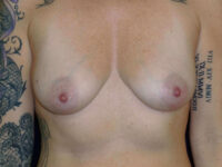 before breast augmentation front view of female patient 2318