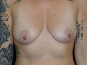 before breast augmentation front view of female patient 2318