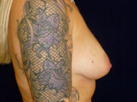 before breast augmentation right side view of female patient 2318