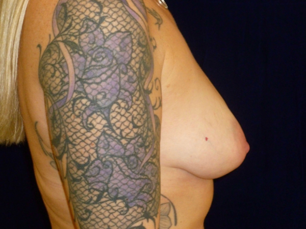 before breast augmentation right side view of female patient 2318