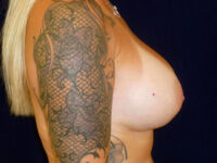 after breast augmentation right side view of female patient 2318