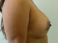 after breast augmentation right side view of female patient 2329