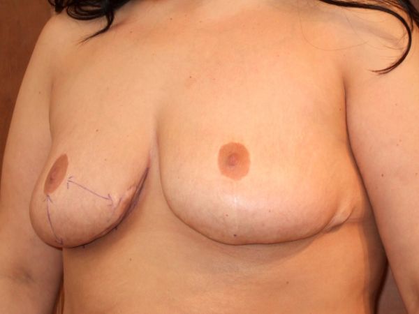 breast augmentation revision patient