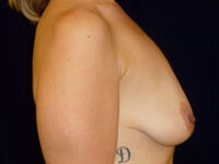 breast augmentation with lift patient