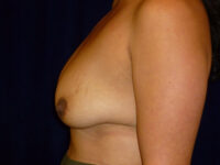 breast augmentation with lift patient