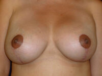 breast augmentation with lift patient